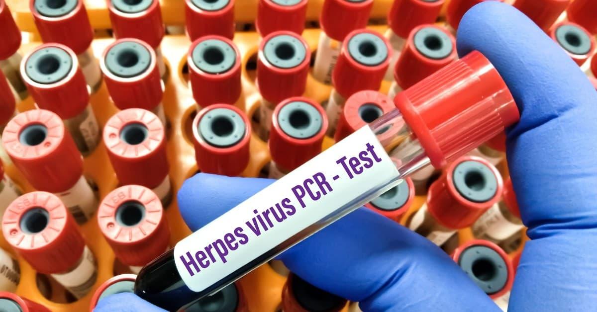 Herpes Virus PCR Tests