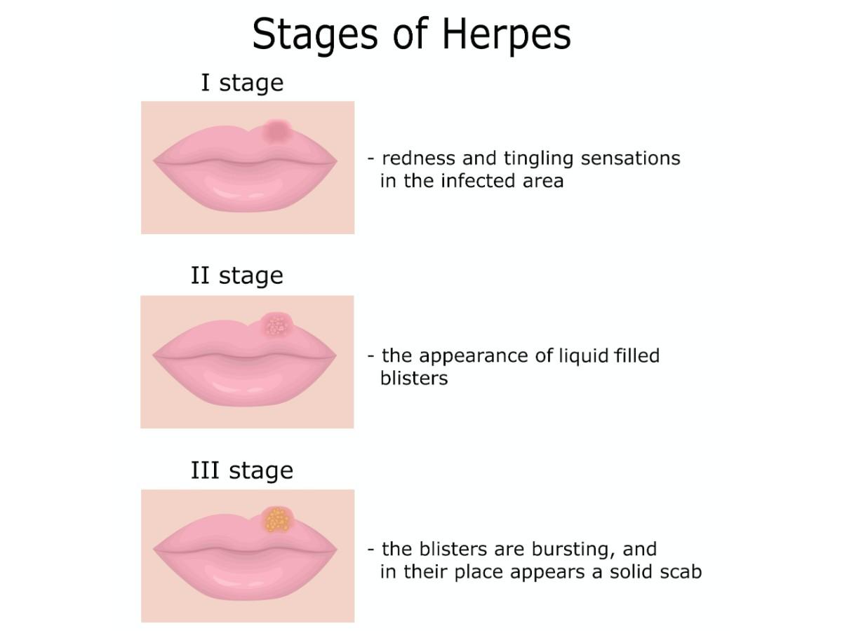 Stages of Herpes