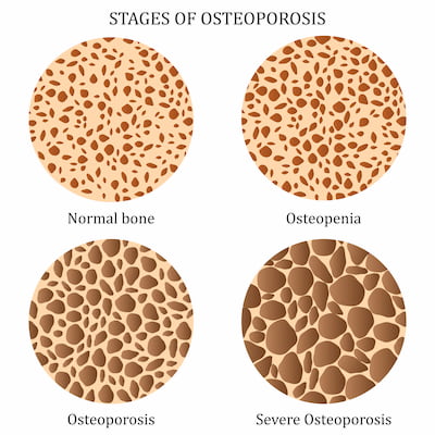Medical illustration of healthy bone and bones with different stages of osteoporosis.