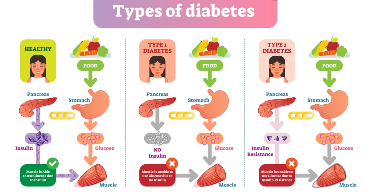 Health care information diagram with Type 1 and Type 2 diabetes