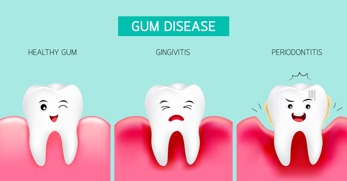 stages of gum disease shown