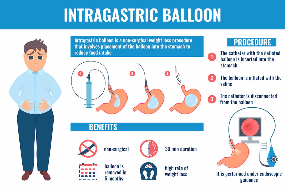 Intragastric balloon medical infographic banner.