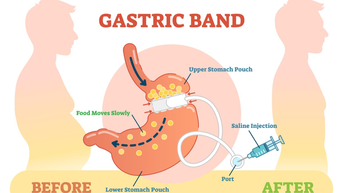 Gastric Band anatomical vector illustration