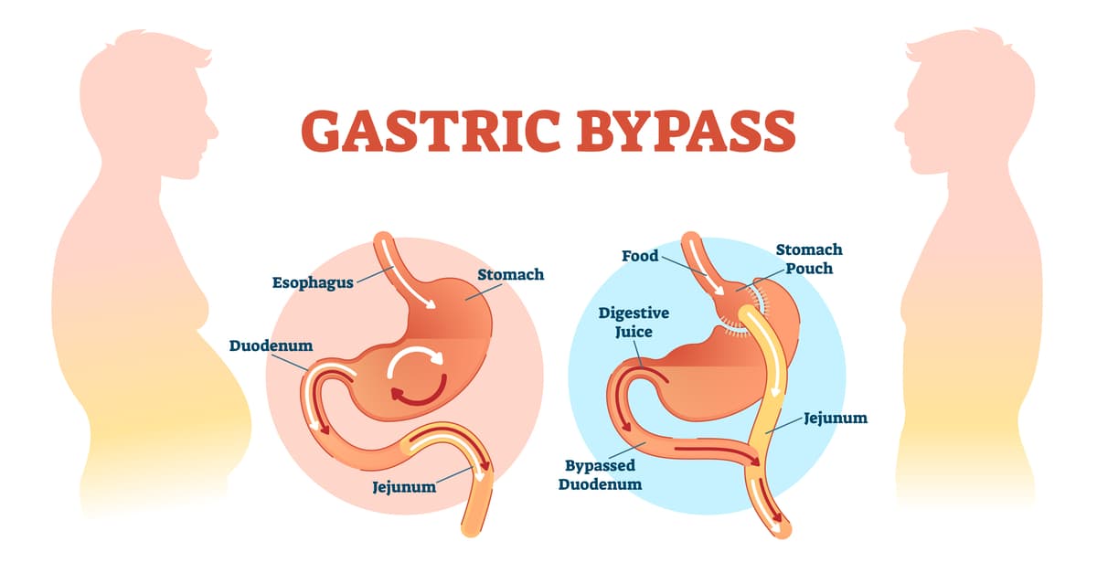 Gastric bypass medical surgery procedure vector.