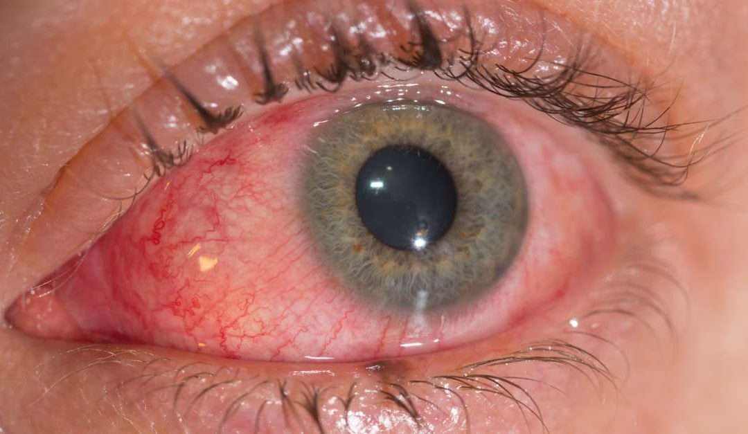 The viral conjunctivitis during eye examination.