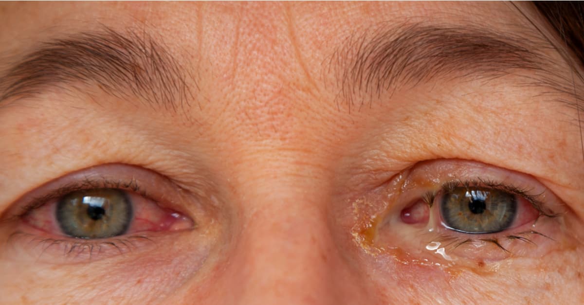 A female with viral conjunctivitis. Both eyes are red and the left eye also has yellow discharge.