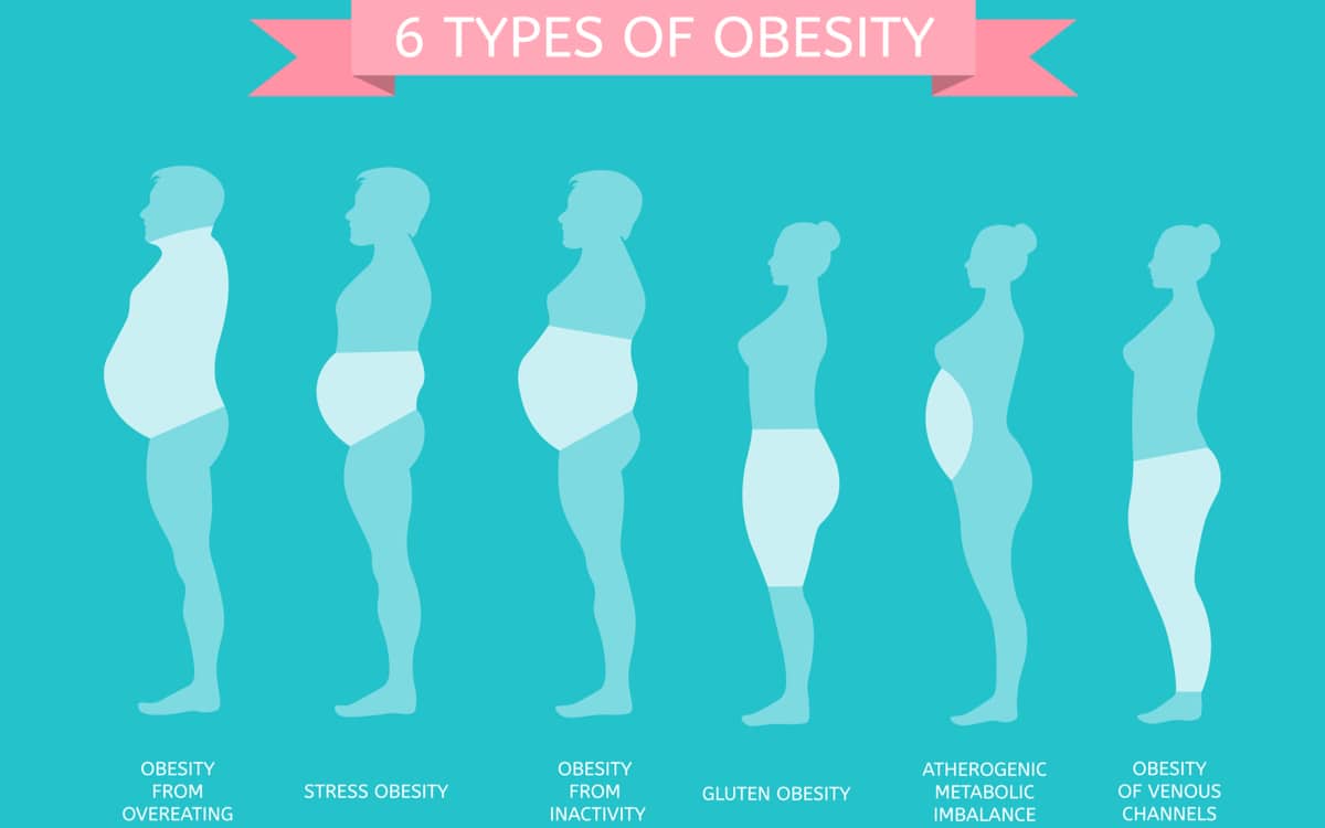 Male and female figures in profile showing 6 types of obesity.