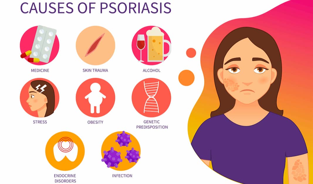 Vector poster showing the causes of psoriasis