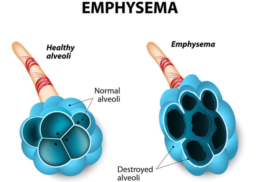 Damage to the air sacs in lungs caused by Emphysema