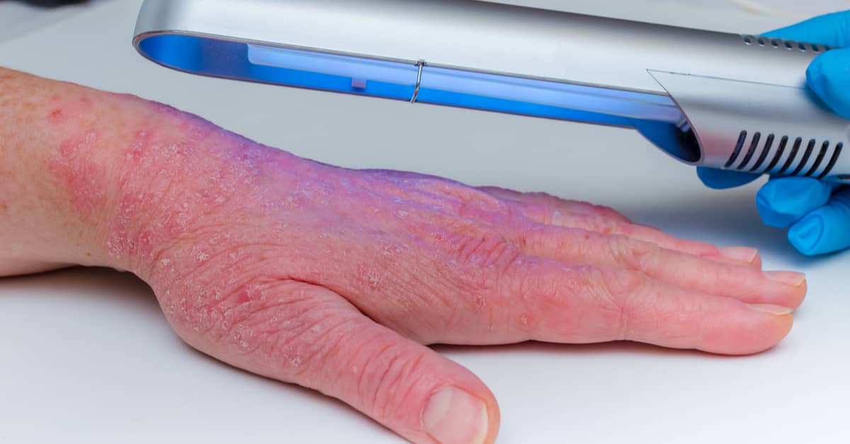 Phototherapy dermatosis being used for treatment of a skin disease