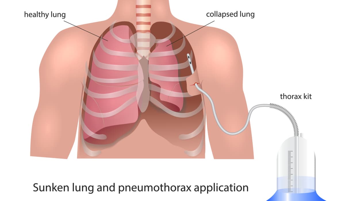 Treatment for pneumothorax (collapsed lung) caused by emphysema