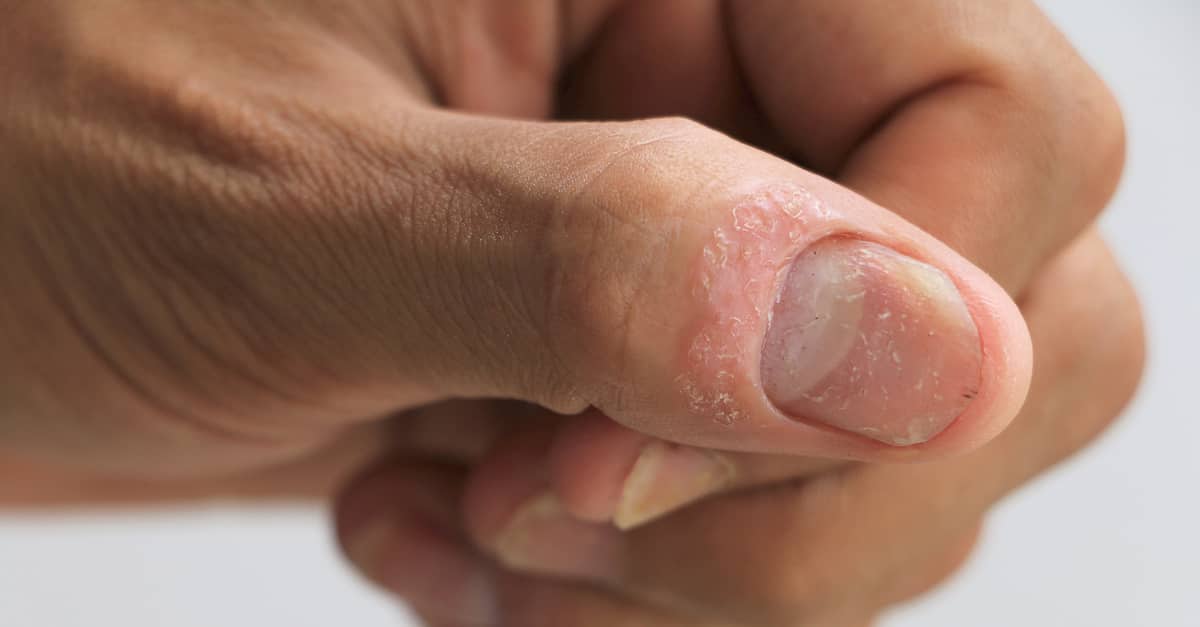 A nail showing symptoms of Psoriasis