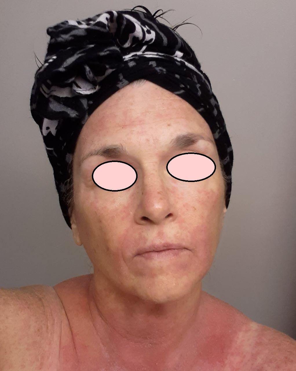 woman with eczema