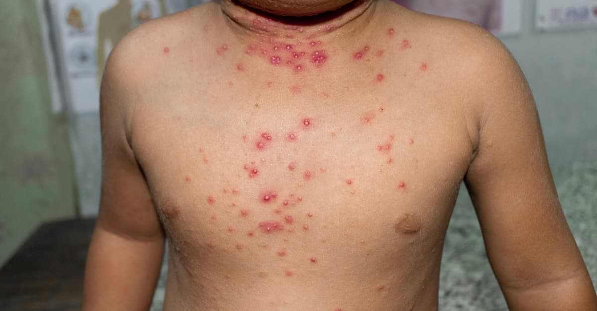 Multiple viral skin lesions called Molluscum Contagiosum on a child