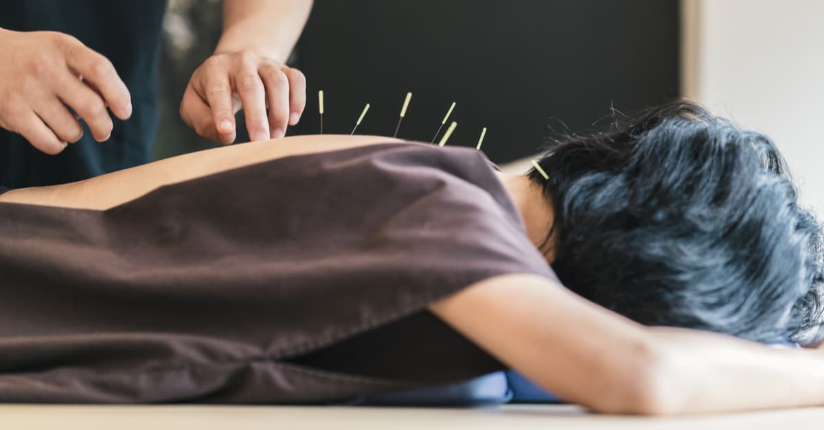 Woman getting acupuncture on her back, a popular traditional chinese medicine