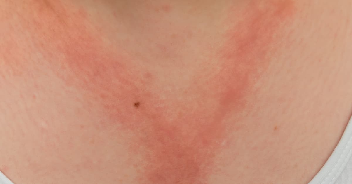 A lady with allergic contact eczema red rash on chest and neck from reaction to nickel jewelery necklace