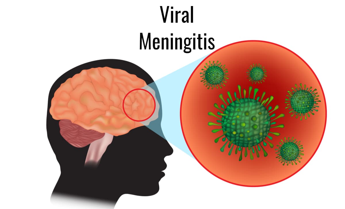 Inflammation of the brain - viral meningitis and encephalitis