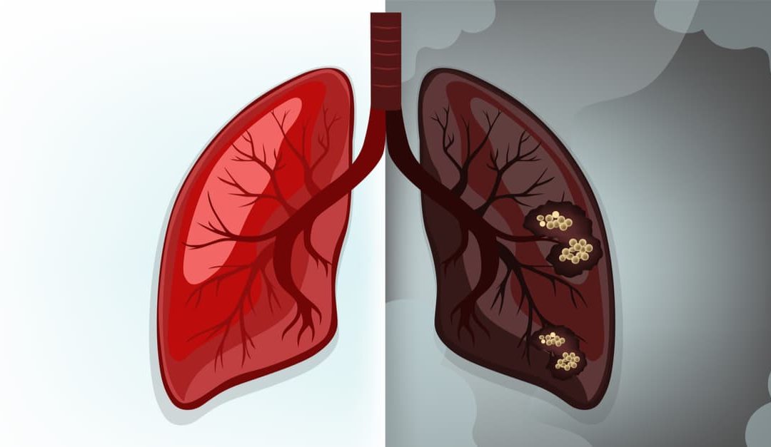 Lung Cancer: Symptoms and Treatments