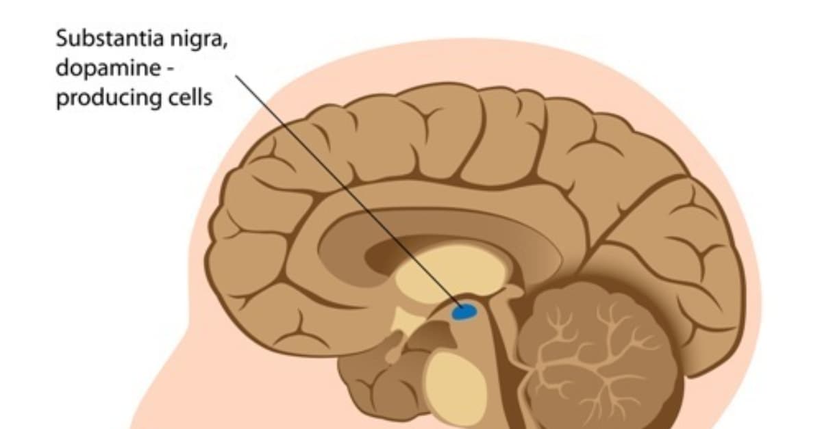 Parkinson's disease is characterized by the loss of neurons in the substantia nigra