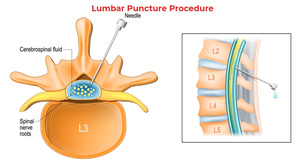 Symptomatic treatments may include serial lumbar punctures